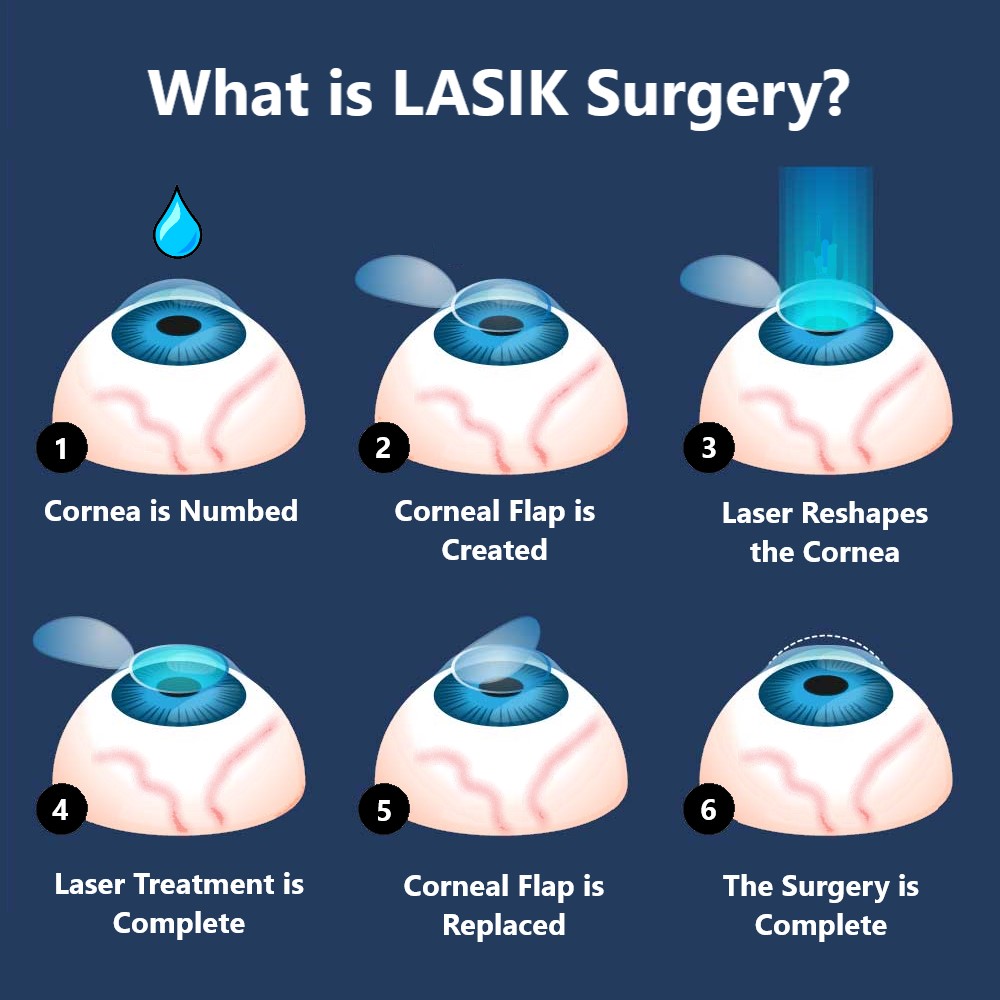 Will health insurance cover lasik